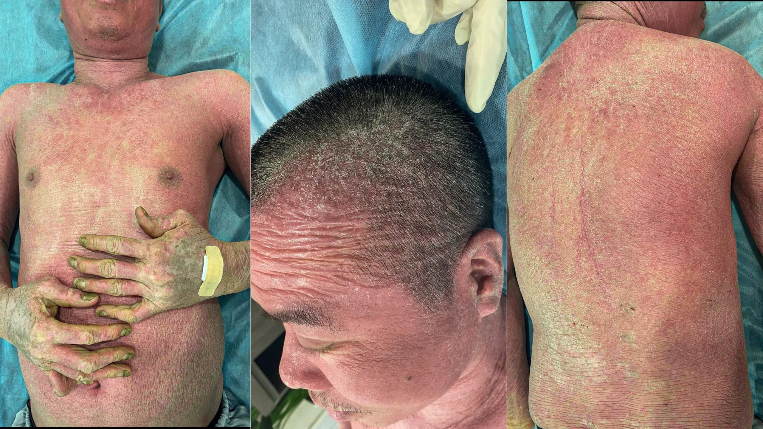 Artritis Psoriatik adalah Ancaman Tersembunyi bagi Jutaan Orang Indonesia